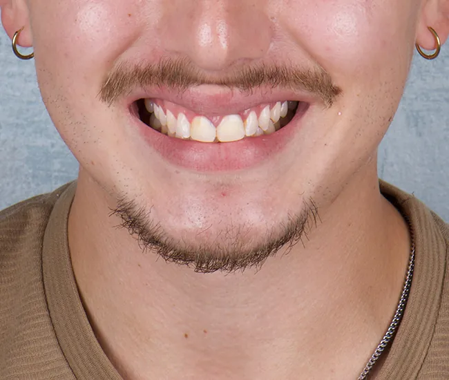 Antes2